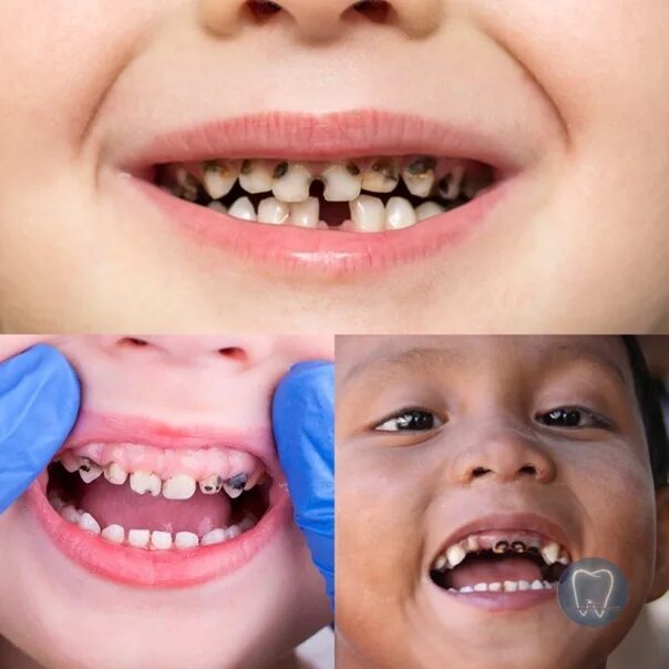 Кариес на молочных зубах у детей фото Blackening of teeth in children can occur for the following reasons: -microbial 