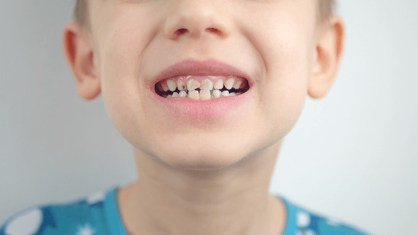 Кариес на молочных зубах у детей фото Baby bad teeth: лицензируемые стоковые фотографии без лицензионных платежей (роя