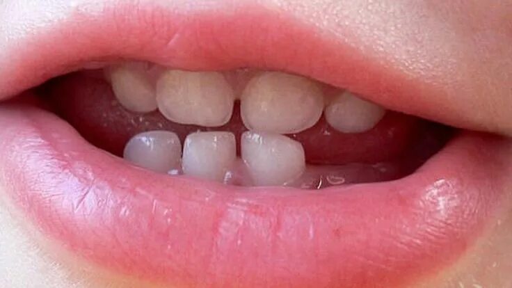 Кариес на молочных зубах у детей фото Importance of Keeping Baby Teeth for Future Health