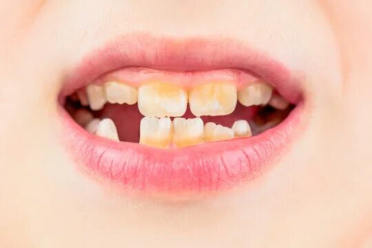 Кариес на молочных зубах у детей фото Bad Teeth Smile Изображения: просматривайте стоковые фотографии, векторные изобр