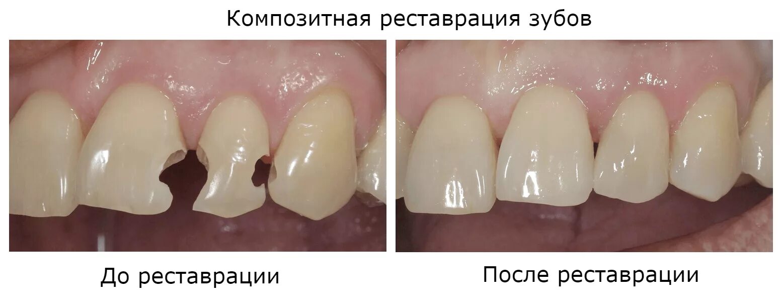 Кариес передних зубов фото у взрослых Реставрация зубов композитным материалом