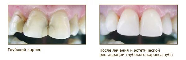 Кариес передних зубов лечение фото Препарирование полостей I класса по Блеку. Классификация кариеса по степени пора