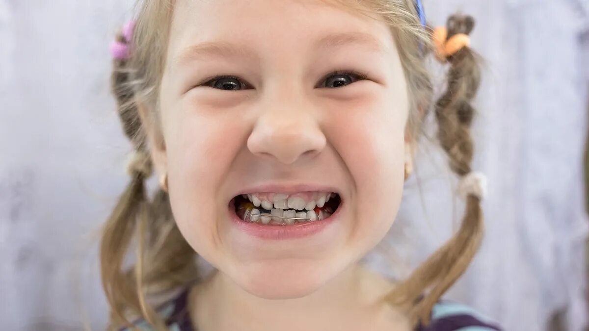 Кариес у детей фото стадии Dental Advice & Oral Health Blog - Ask the Dentist