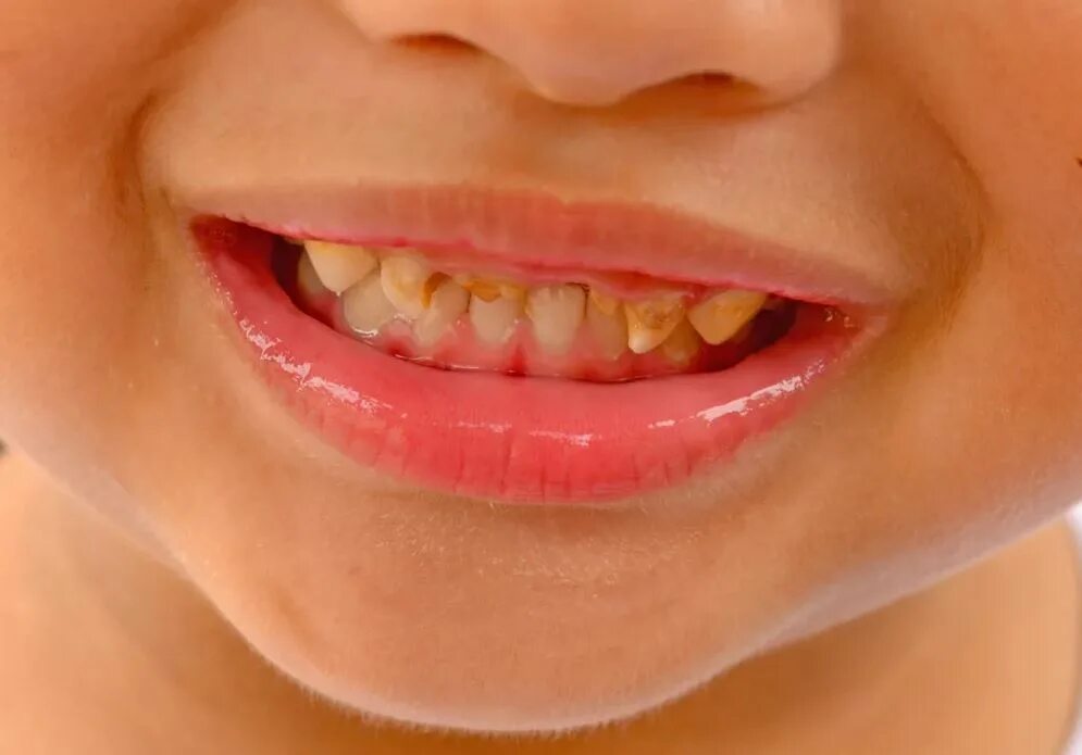 Кариес у детей фото стадии Лечение кариеса у детей в Смоленске в стоматологии Family Smile, цены и процедур