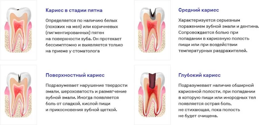 Кариес в стадии белого пятна фото Лечение кариеса передних зубов недорого в Реутове и Новокосино - стоматология Кр