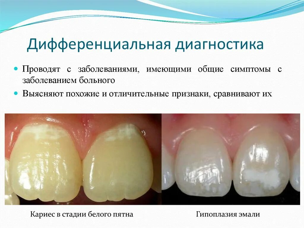 Кариес в стадии белого пятна фото Тон становиться более