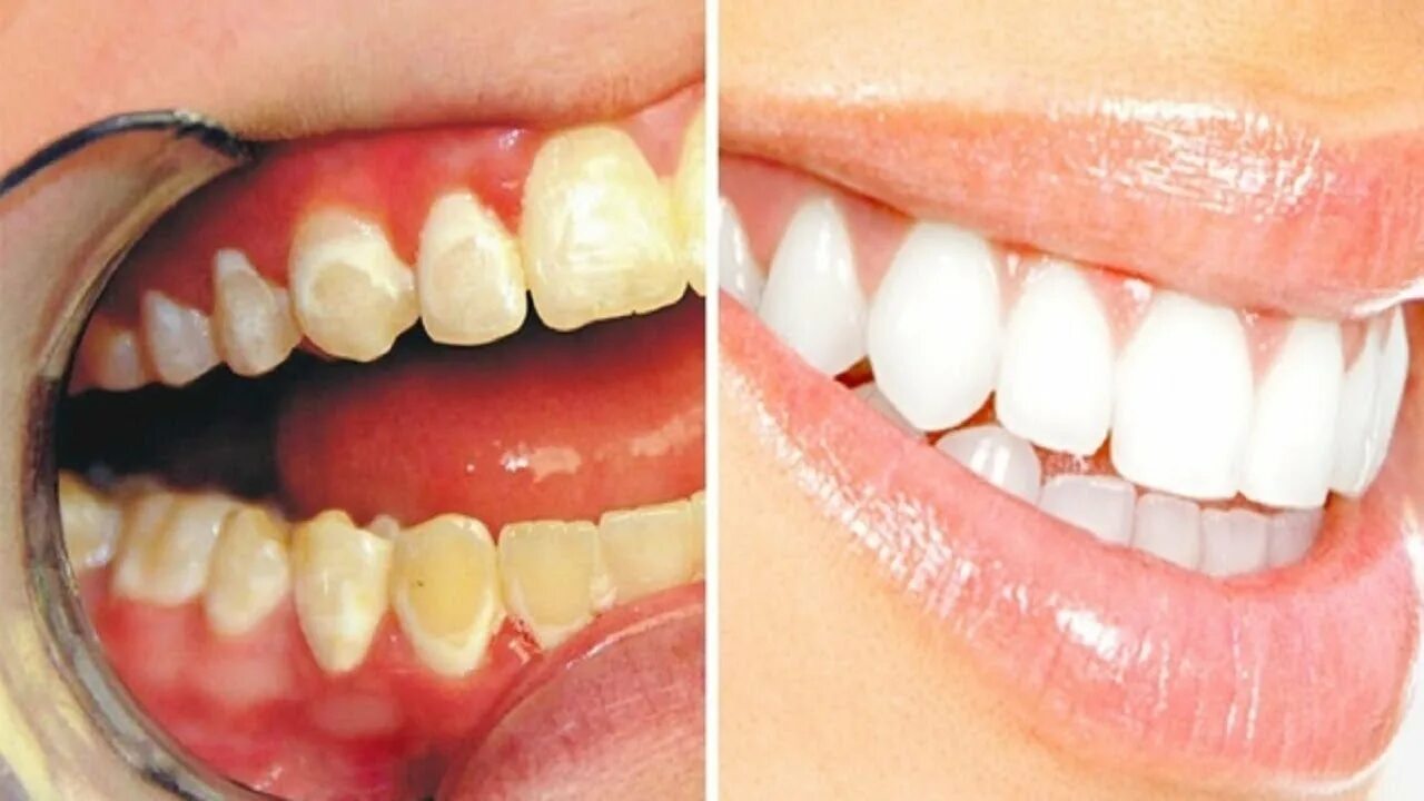 Кариес в стадии белого пятна фото A Product In Your Kitchen Is Enough To Deal With Your Teeth Issues - YouTube