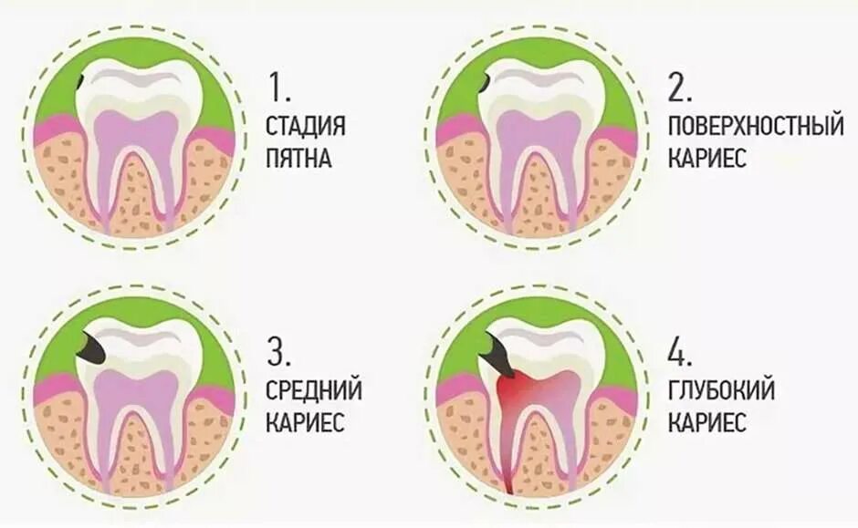 Кариес в стадии пятна фото Зубная бoль и кариес - АУ "Городская стоматологическая поликлиника" Минздрава Чу