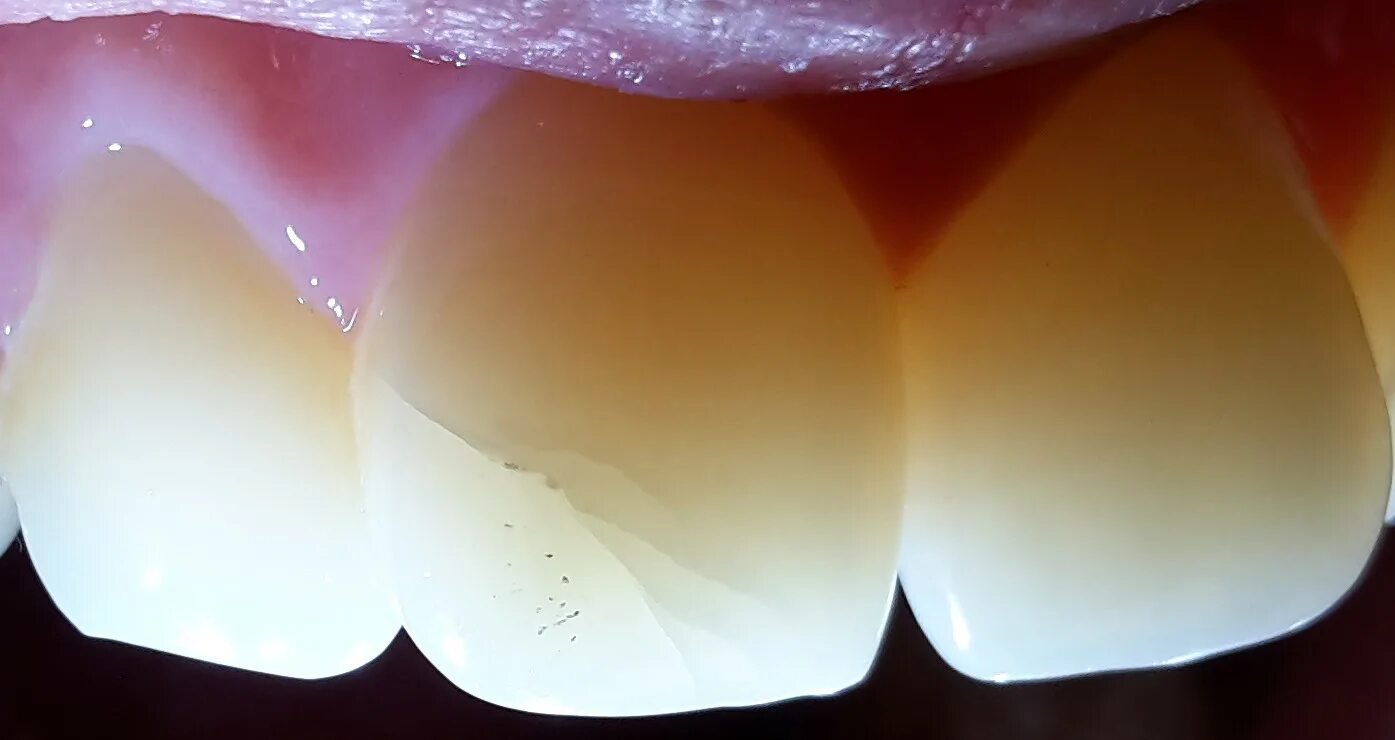 Кариес в стадии пятна фото dentistry - How dangerous are cracked teeth? - Medical Sciences Stack Exchange