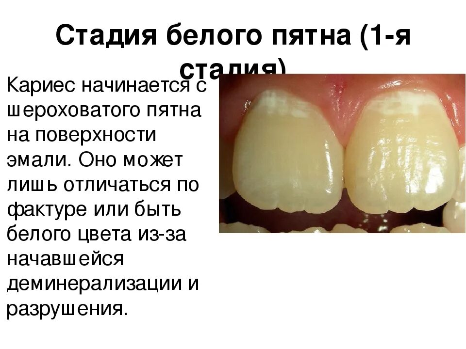 Кариес в стадии пятна фото Картинки МИКРОЭЛЕМЕНТЫ ЗУБНОГО НАЛЕТА