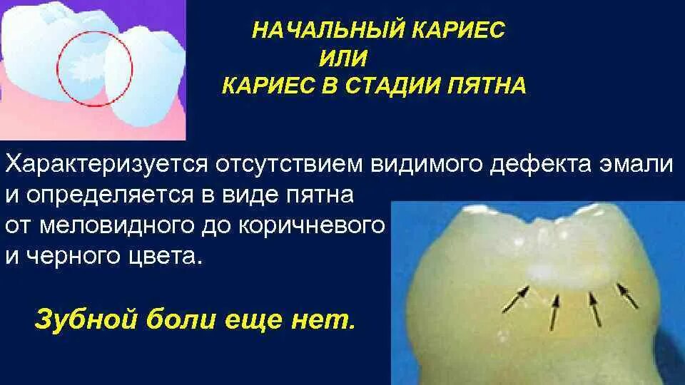 Кариес в стадии пятна фото Диагностика стадии пятна Shtampik.com