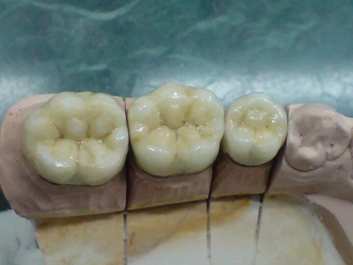 Кариес жевательных зубов фото SÜEL Dentlab Esthetic Anatomía dental, Arte dental, Laboratorio dental