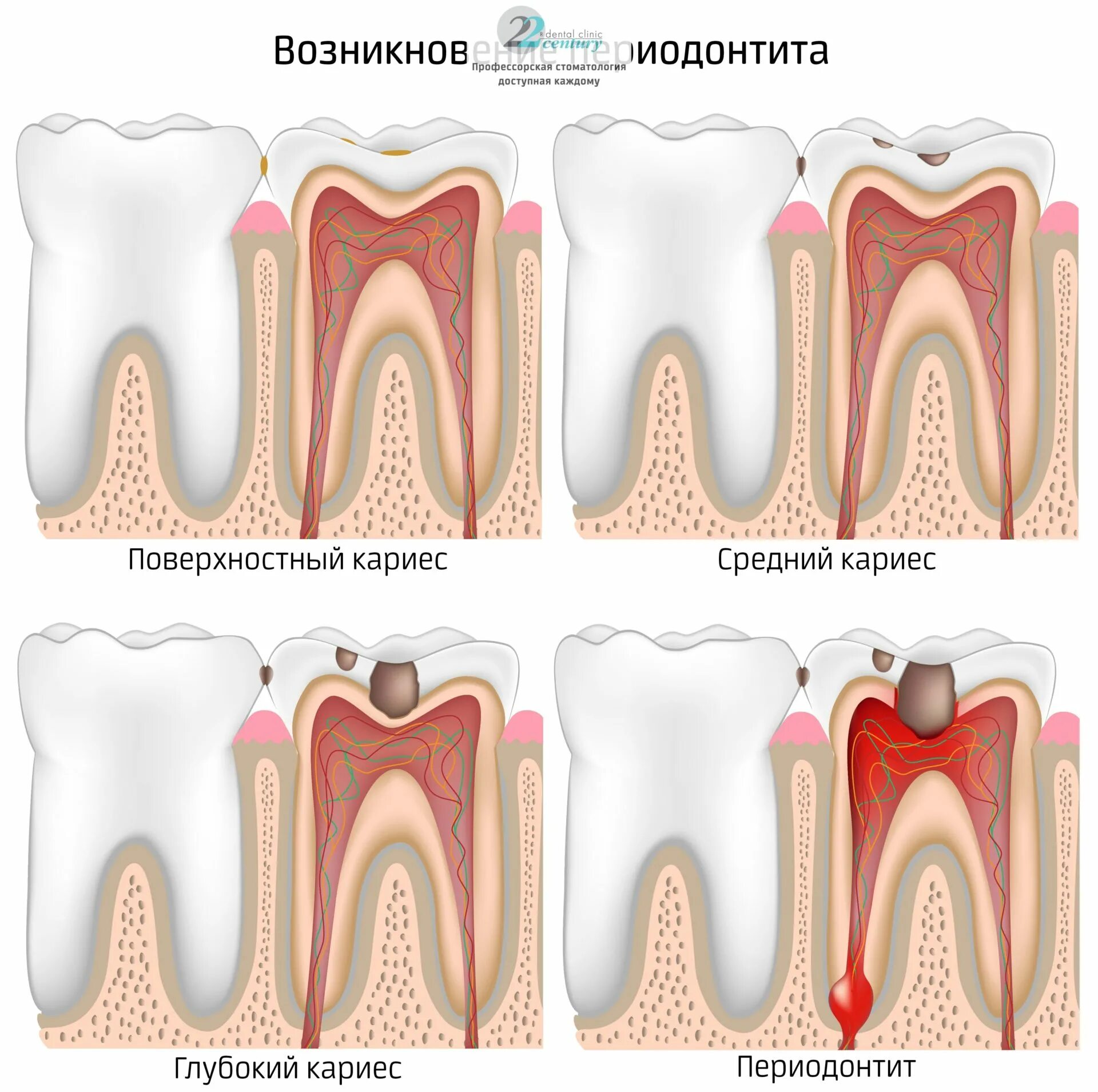 Кариес зуба мудрости фото Лечение острого периодонтита зубов в стоматологии - цены в Москве
