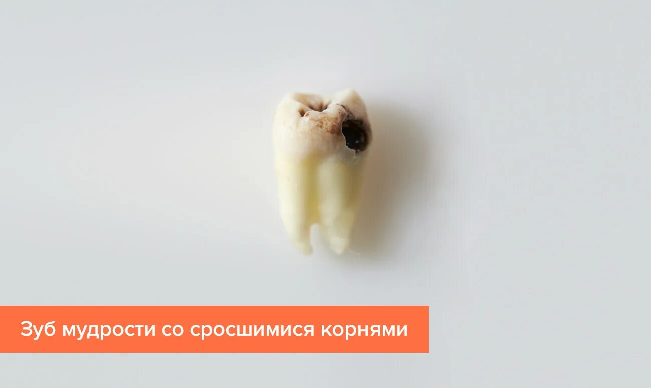 Кариес зуба мудрости фото Зуб мудрости у человека - что это, строение, особенности, как растет "восьмерка"