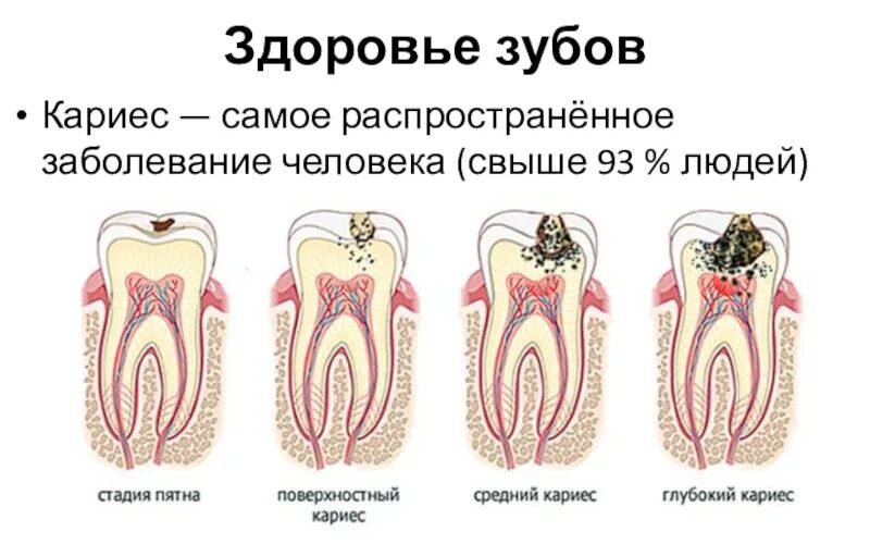Кариес зуба мудрости фото Болит голова после лечения зуба