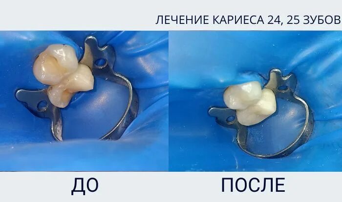 Кариес зуба мудрости фото Лечение кариеса 24, 25 зубов, восстановление анатомической формы зубов Примеры р