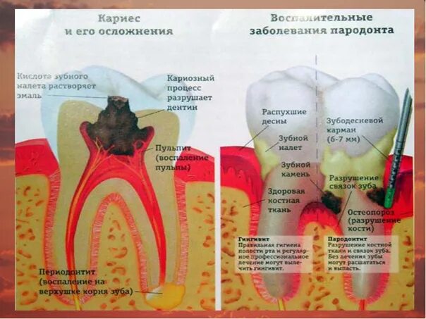 Кариес зуба мудрости фото Что такое кариес простыми словами