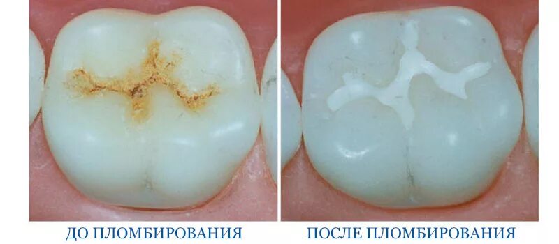 Кариес зуба мудрости фото Коронка или пломба Стоматология в Кудрово