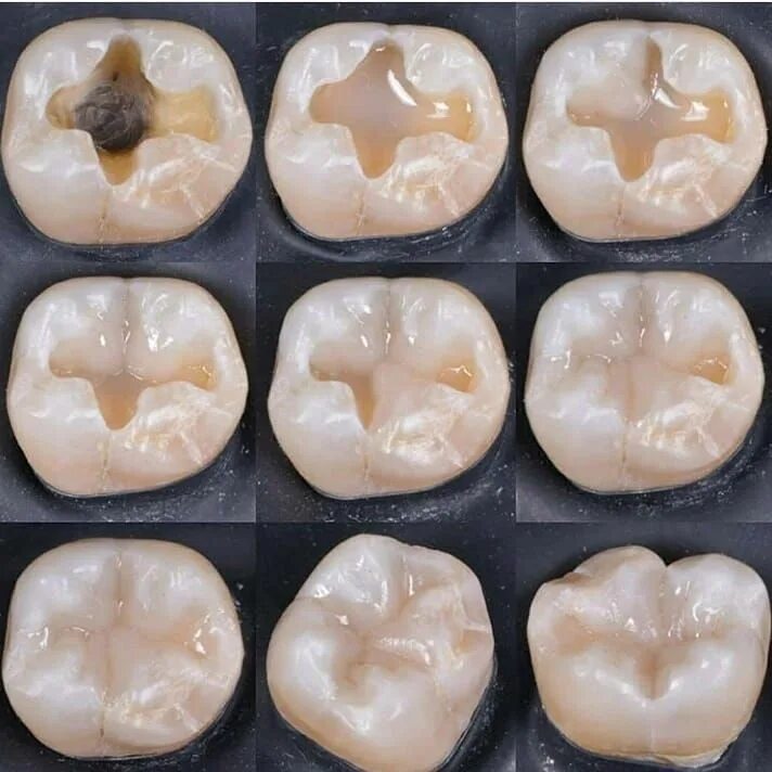 Кариес зубов фото у взрослых Pin by JAMES. on * SENRI ATSUKO Dental fillings, Restorative dentistry, Dental c