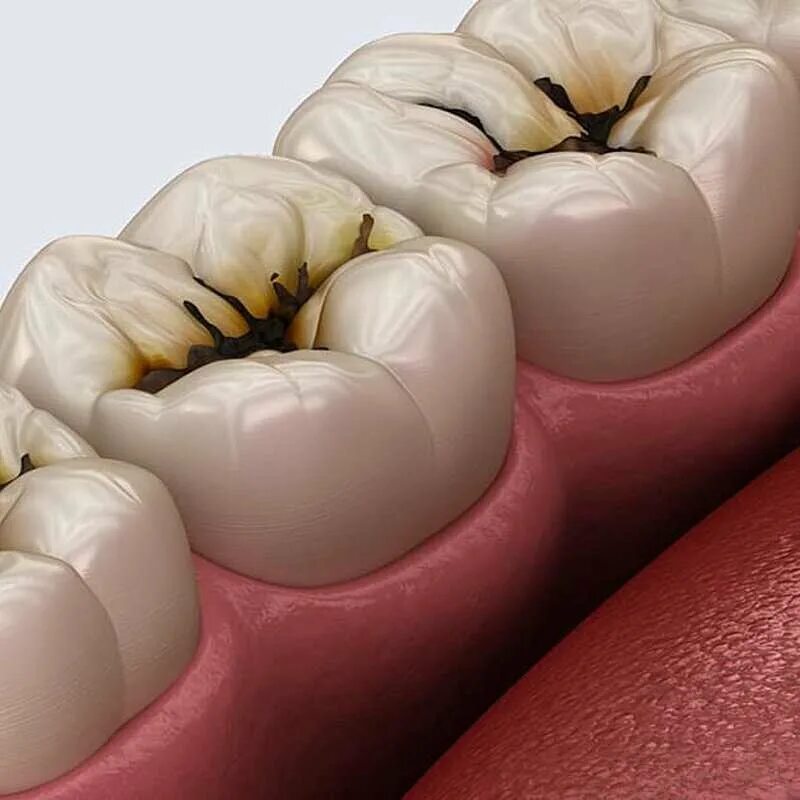 Кариес зубов фото у взрослых лечение Цены ProfDental на улице Мира в Мытищах, Москва - Zoon