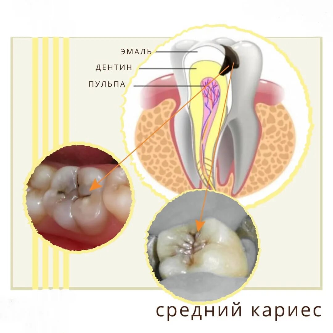 Кариес зубов фото у взрослых лечение Лечение кариеса: стоимость, виды, симптомы стоматология Нардент(МСК)