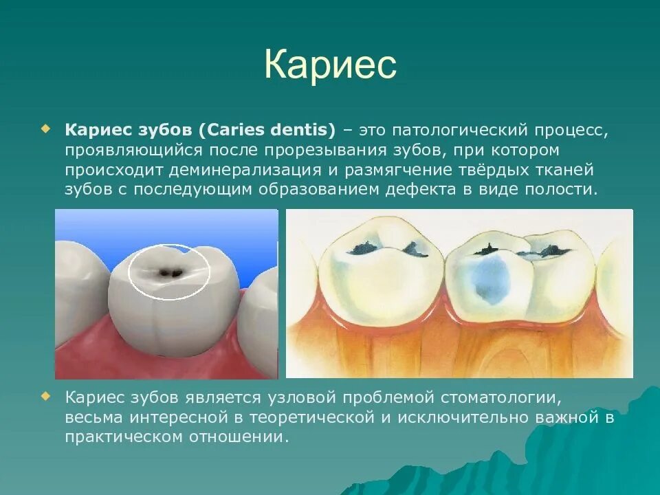 Кариес зубов фото у взрослых лечение Напоминаем Вам об обязательном посещении врача-стоматолога 1 раз в год. 2023 Арз