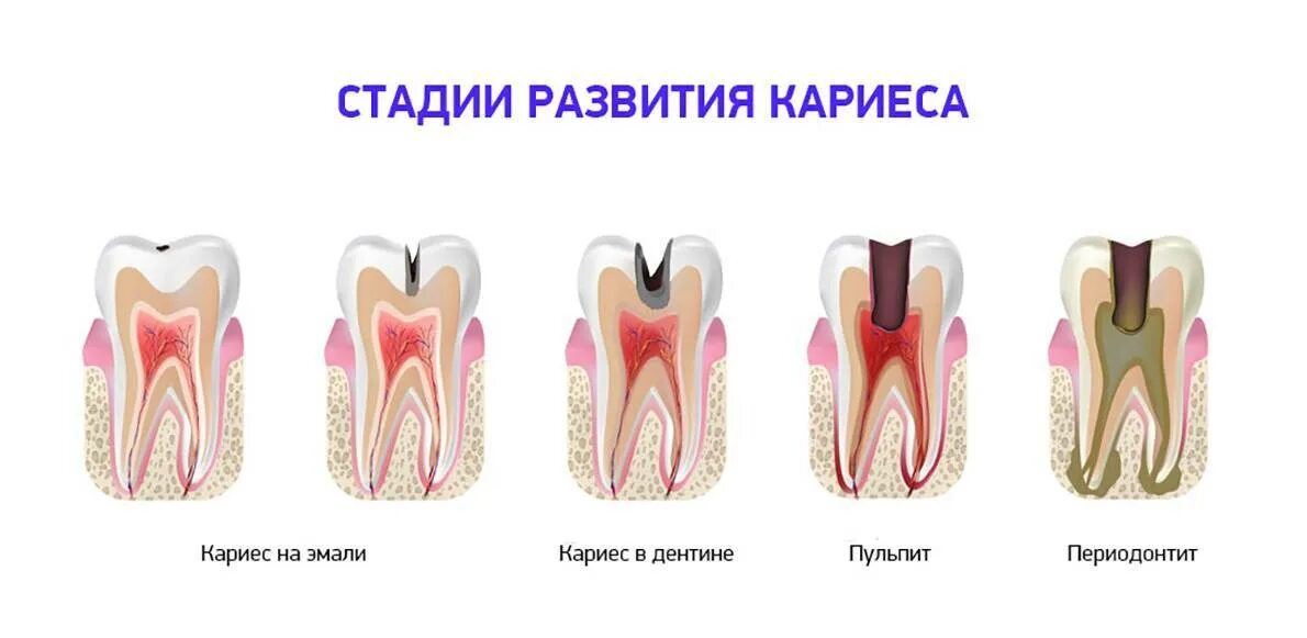 Кариес зубов фото у взрослых лечение Лечение глубокого кариеса зубов, цены в Балашихе