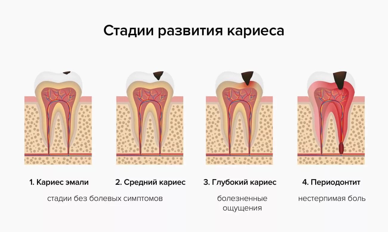 Кариес зубов как выглядит начальная стадия Стадии кариеса: лечение