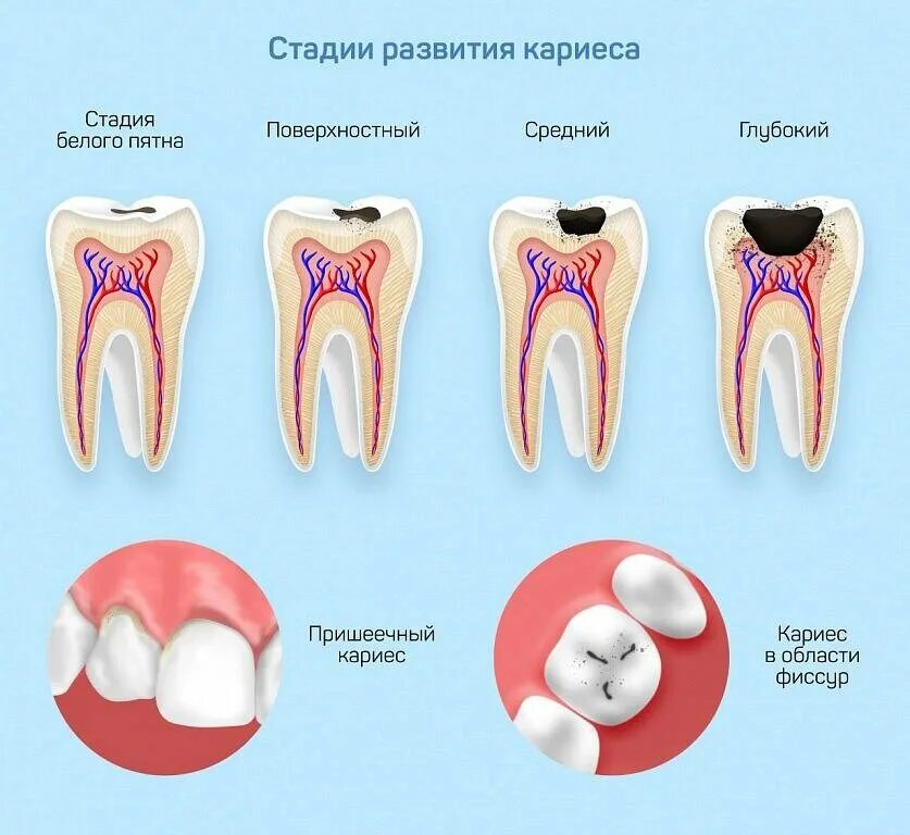 Кариес зубов как выглядит начальная стадия Чтобы зубы не болели: профилактика кариеса у взрослых и детей ДокторСлон Эксперт