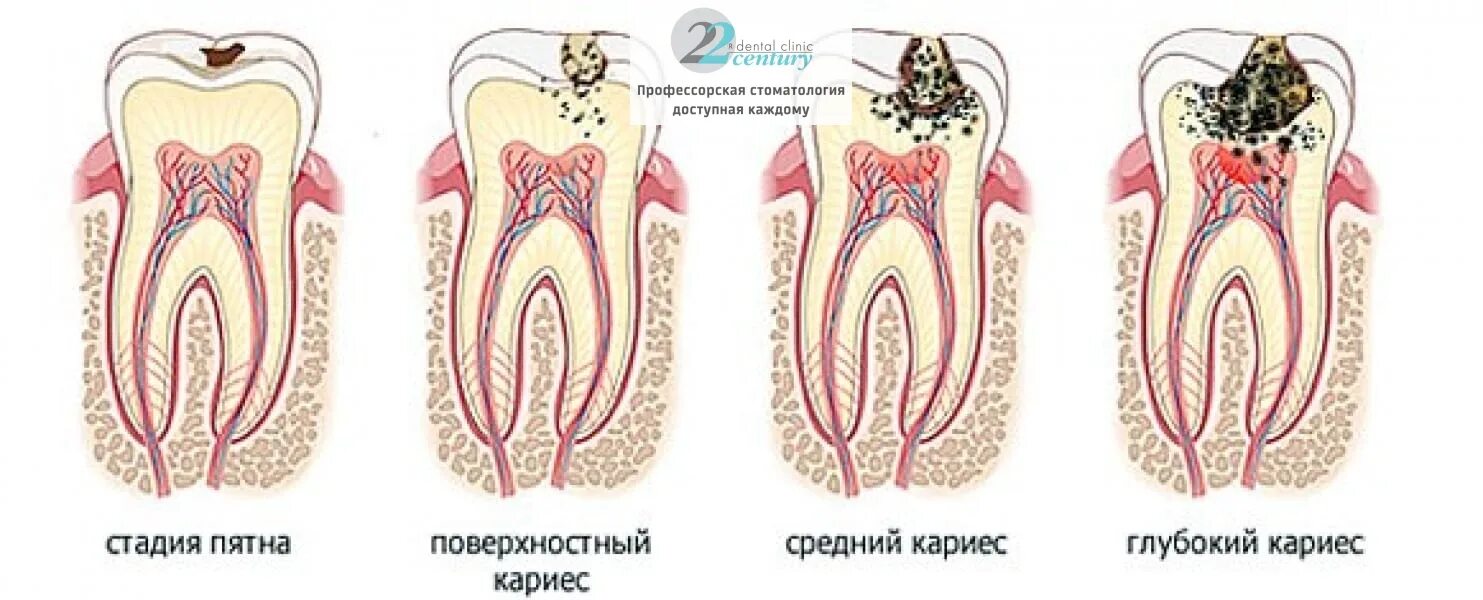 Кариес зубов как выглядит начальная стадия Лечение глубокого кариеса зубов в Москве, цены в стоматологии