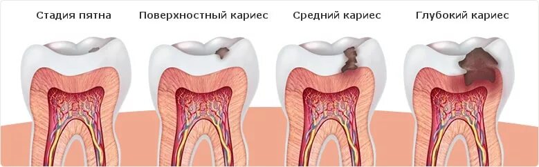 Кариес зубов как выглядит начальная стадия Лечение кариеса зубов - цена в Санкт-Петербурге - Многопрофильные медицинские це