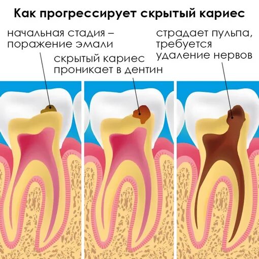 Кариес зубов как выглядит начальная стадия Лечение скрытого кариеса в Клинике Здоровья Исток в Звенигороде