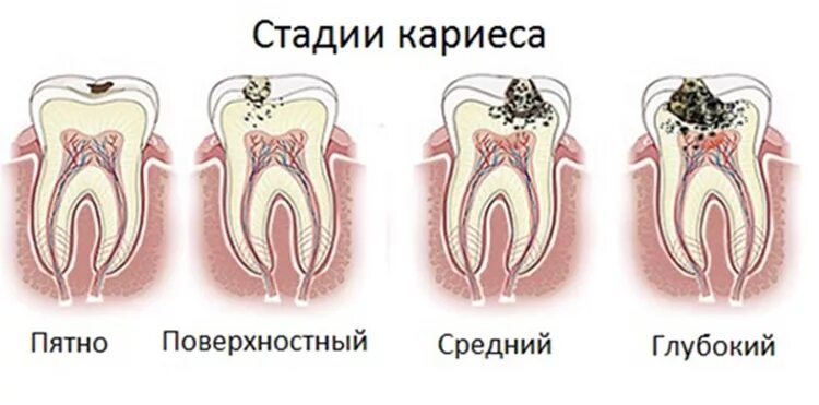 Кариес зубов как выглядит начальная стадия Стадии кариеса - диагноз, лечение и профилактика заболевания в Екатеринбурге