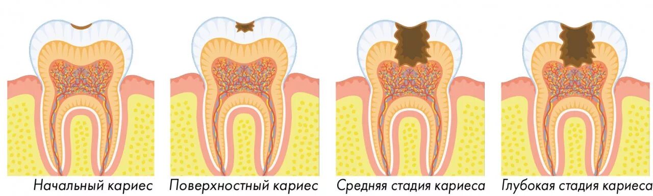 Кариес зубов как выглядит начальная стадия Кариес - самое распространенное стоматологическое заболевание