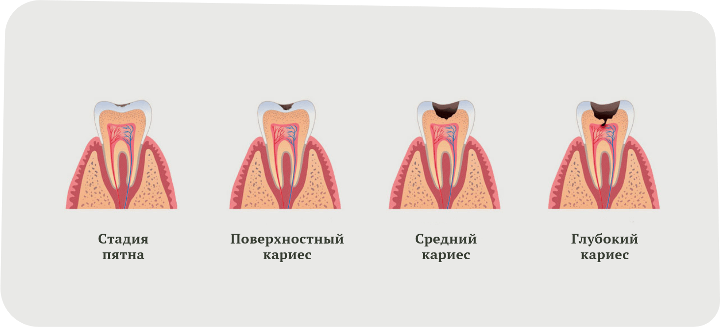 Кариес зубов как выглядит начальная стадия Лечение кариеса зубов, цены в Москве