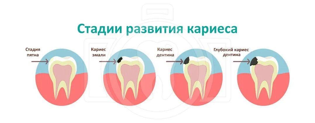 Кариес зубов как выглядит начальная стадия Лечение кариеса зубов в Харькове - описание, адреса, цены и отзывы на Харьков Де