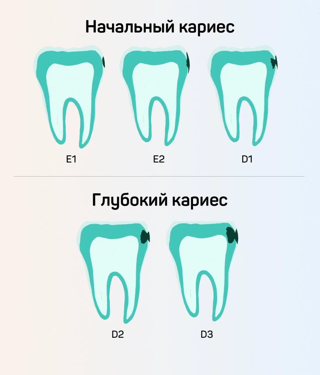 Кариес зубов как выглядит начальная стадия Icon лечение кариеса без сверления в Москве - цены, этапы
