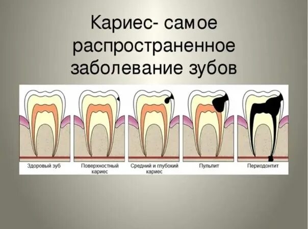 Кариес зубов как выглядит начальная стадия Модель кариозной системы хонкай