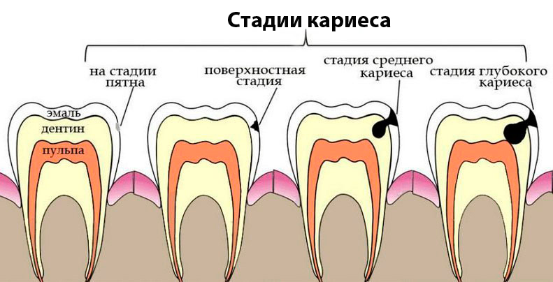 Кариес зубов как выглядит начальная стадия Стадии кариозной инфекции зубов - выявление и лечение