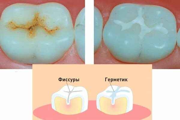 Кариеса зубов фото лечение Герметизация фиссур у детей, цены в детской стоматологии "Жемчужина Севера"