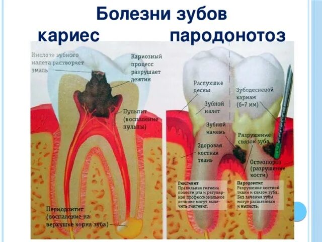 Кариеса зубов фото лечение "Строение и значение зубов". Презентация к уроку биологии.