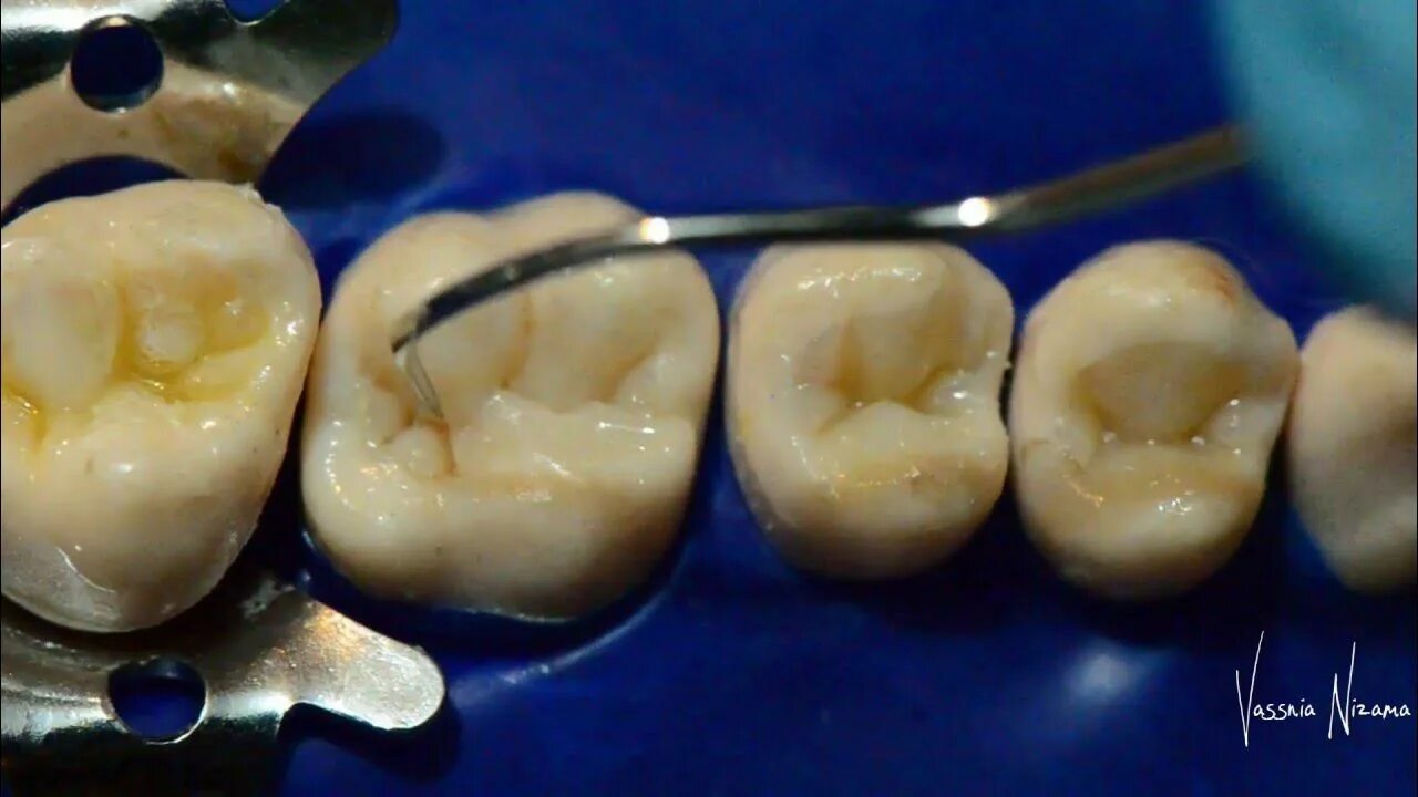 Кариозные зубы фото Clase I en dientes posteriores - Filling a class I cavity - YouTube