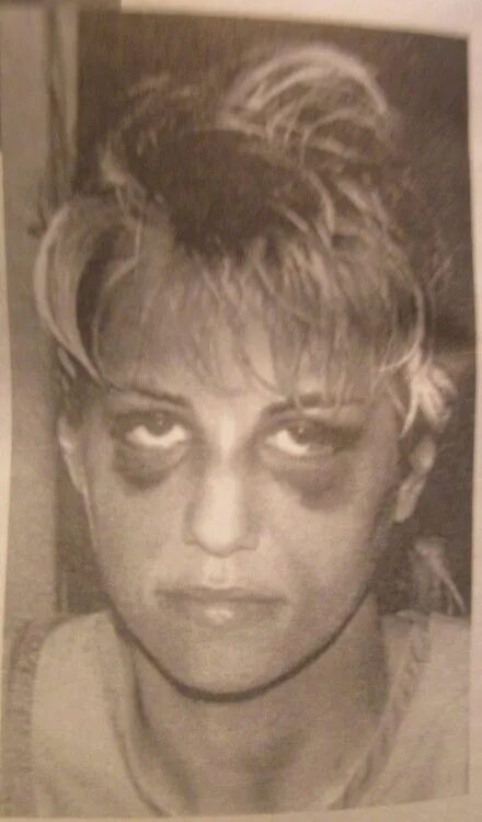 Карла хомолка фото Image result for raccoon eye bruising karla homolka