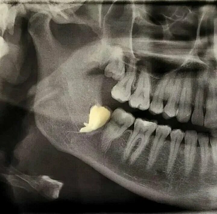 Карман зуба фото Панорама: Happy Dental, стоматологическая клиника, ул. Ленинская Слобода, 4, Мос