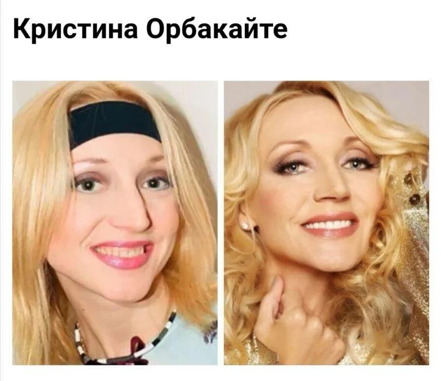 Карнавал пластика до и после фото Еще раз про виниры