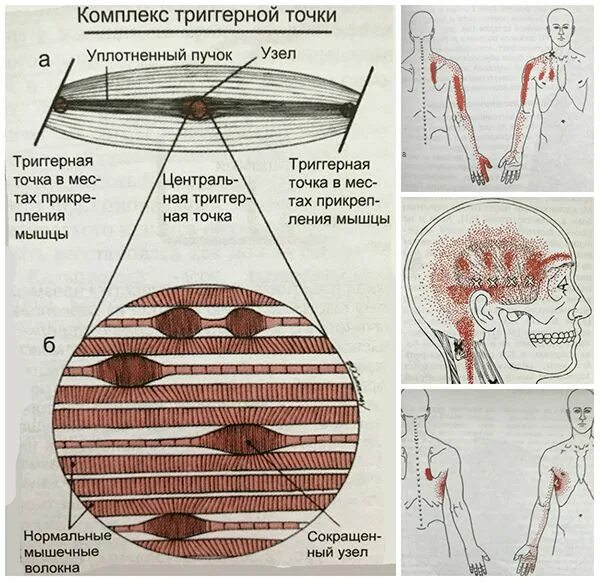 Карта триггерные точки фото Как убрать триггерные точки