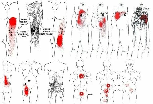Карта триггерные точки фото O que são os Trigger Points e como podem causar Lesões nos Corredores - Corre Sa