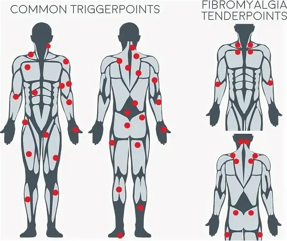 Карта триггерные точки фото 10 популярных идей на тему "trigger point therapy" для вдохновения