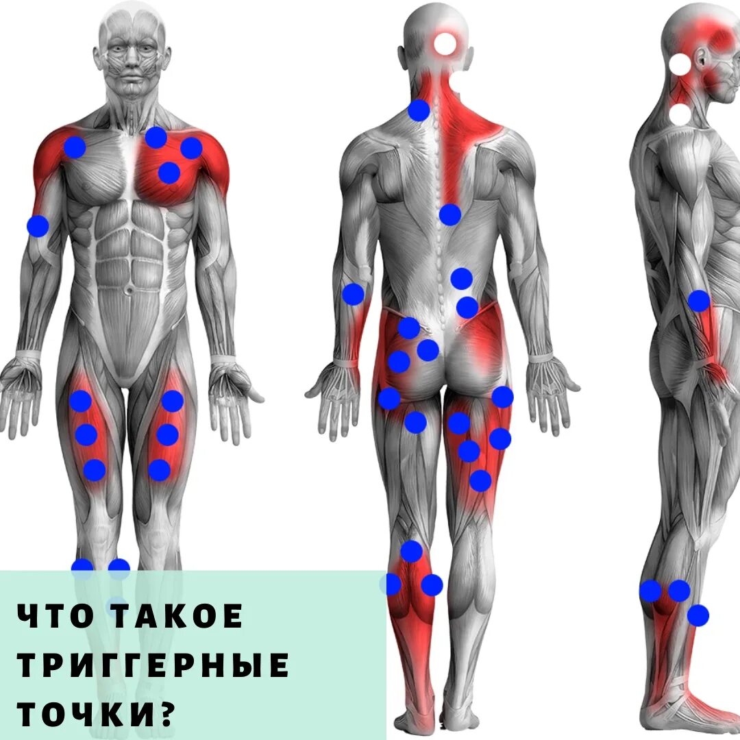 Карта триггерные точки фото Карта триггерных точек с отраженными болями
