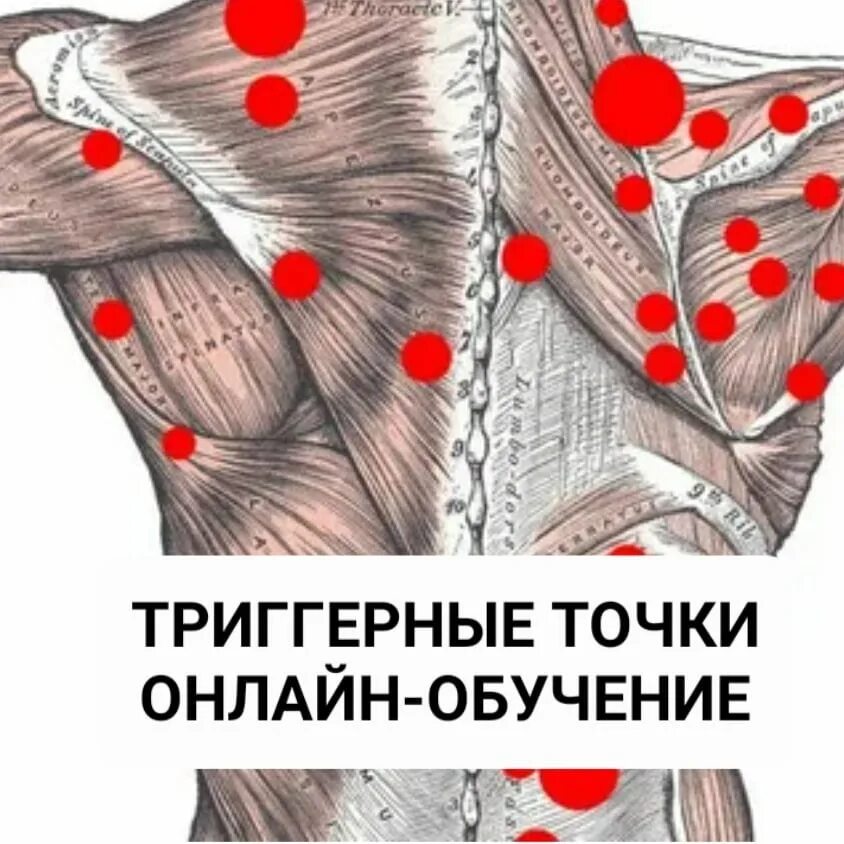 Карта триггерные точки фото Схема триггерных точек